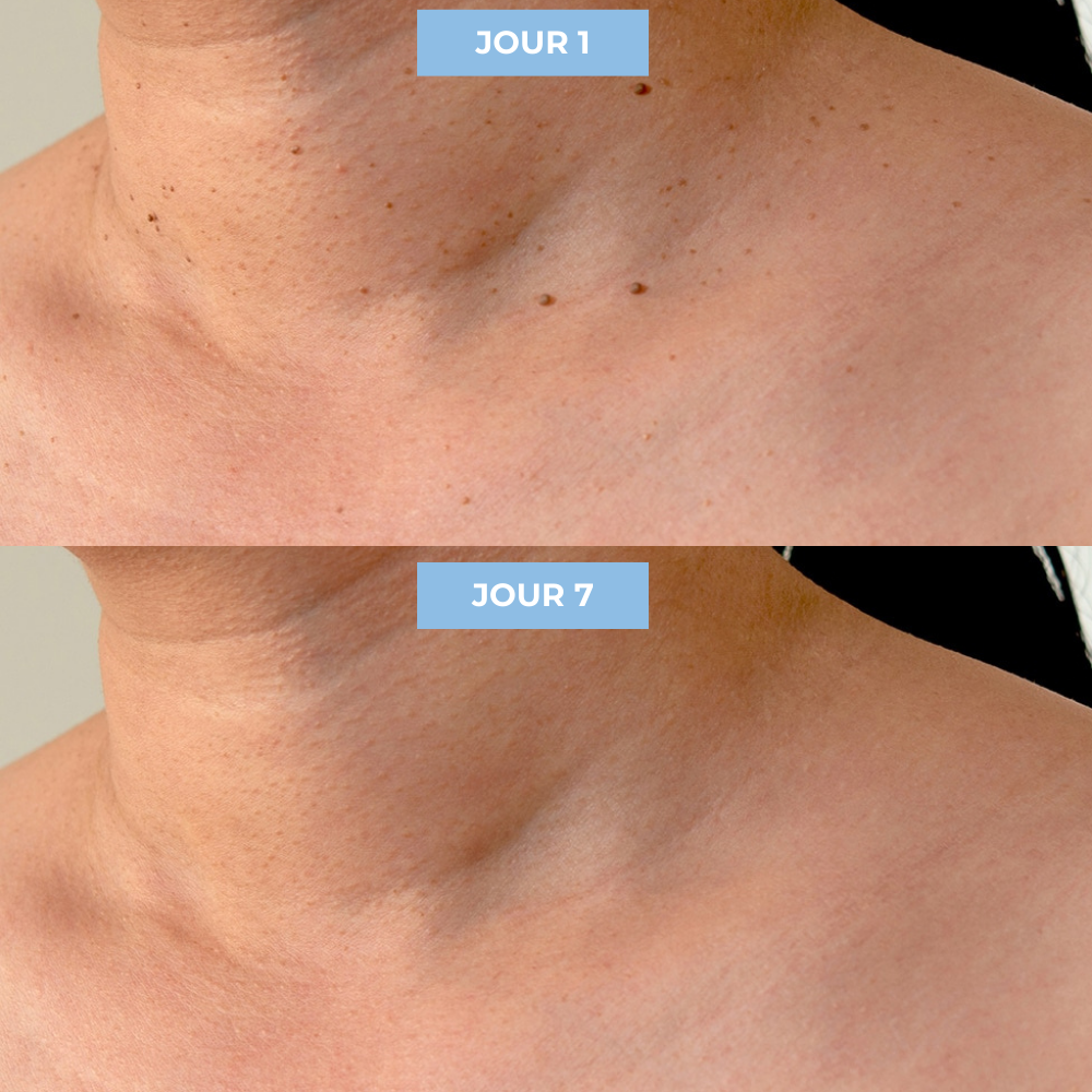 Kit Dermis Skin Pro - Adieu les acrochordons
