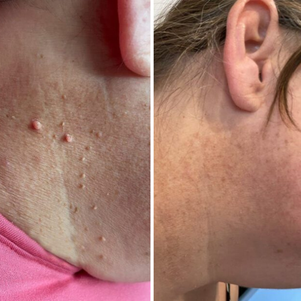 Kit Dermis Skin Pro - Adieu les acrochordons