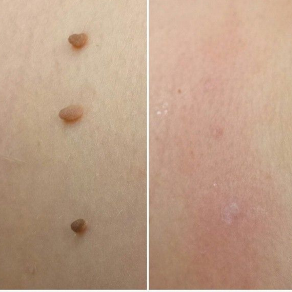 Kit Dermis Skin Pro - Adieu les acrochordons