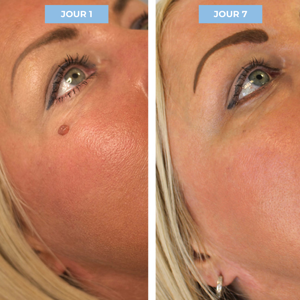 Kit Dermis Skin Pro - Adieu les acrochordons