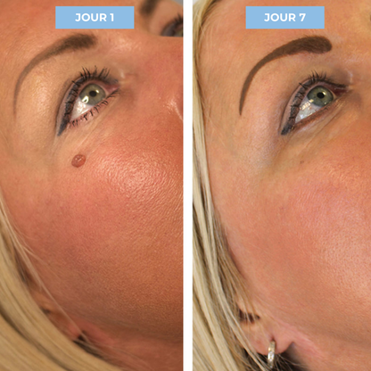 Kit Dermis Skin Pro - Adieu les acrochordons